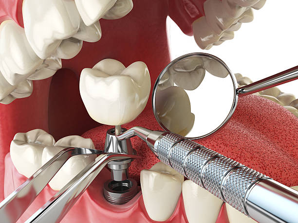Best Emergency Dental Care for Abscessed Tooth in Apple Mountain Lake, VA